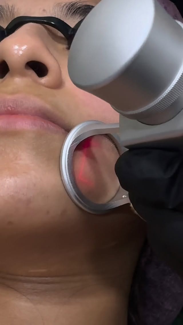 Post 1 by Derma Latina on Instagram (video)
