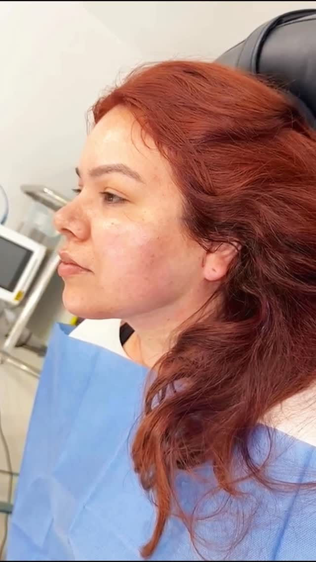 Post 4 by Rafael Valencia, M.D. Aesthetic Medicine on Instagram (video)