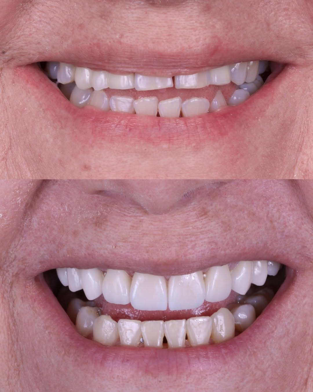 Post 3 by GLOSS DENT MÉXICO ® Carillas Dentales on Instagram (image)