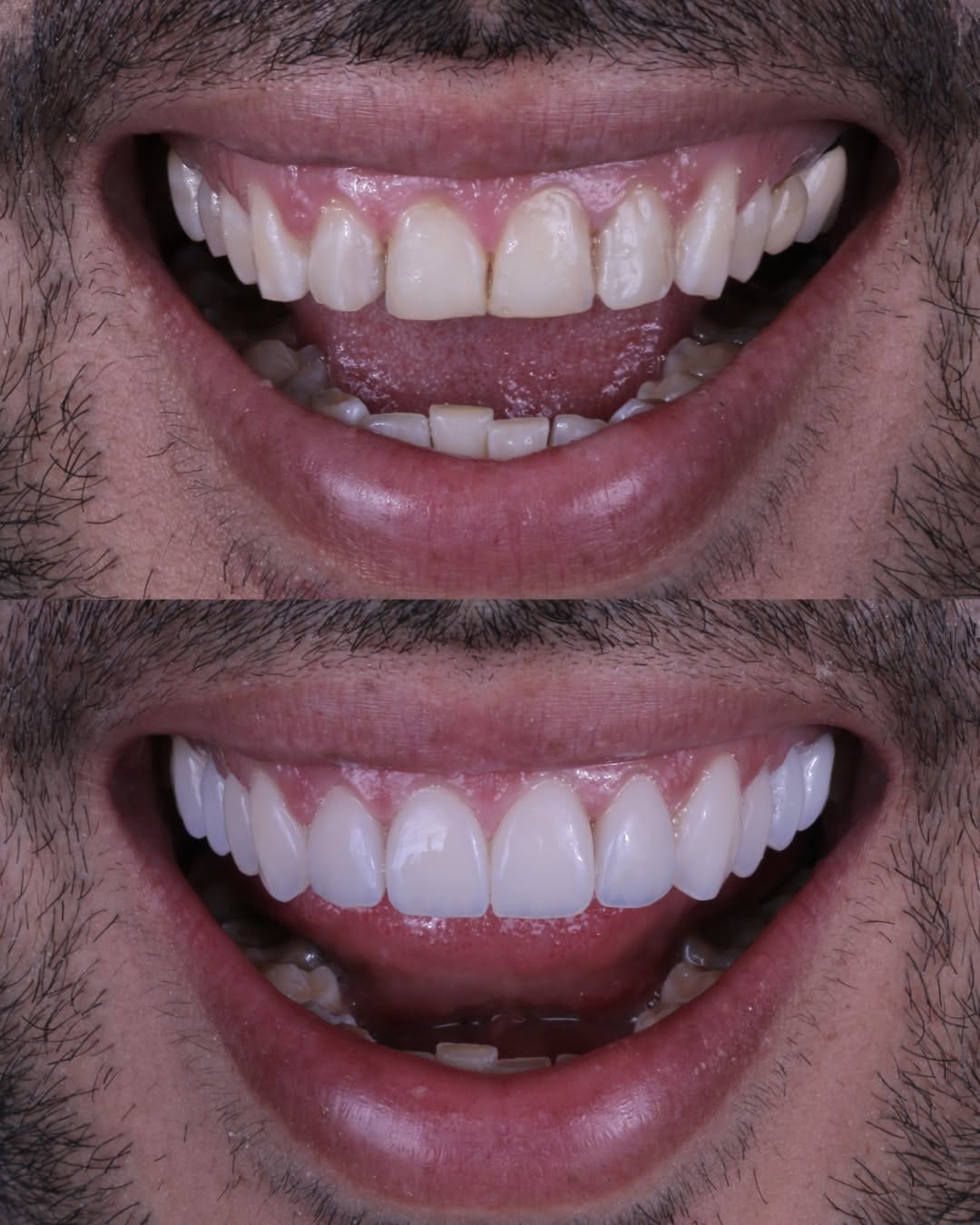 Post 5 by GLOSS DENT MÉXICO ® Carillas Dentales on Instagram (image)