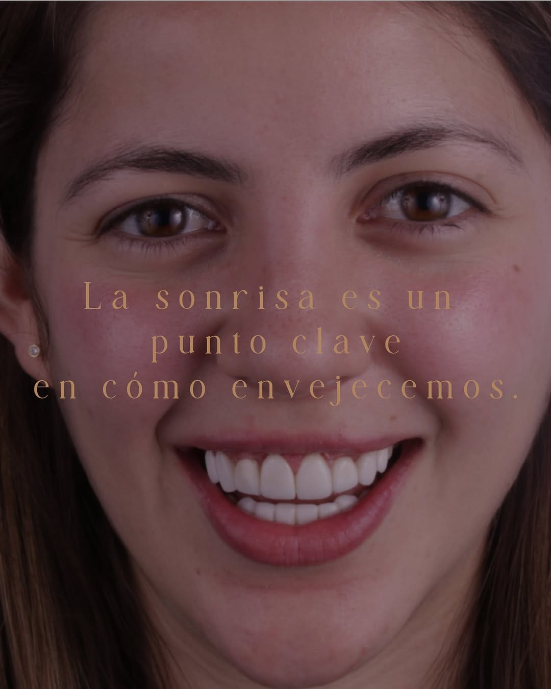 Post 10 by GLOSS DENT MÉXICO ® Carillas Dentales on Instagram (image)