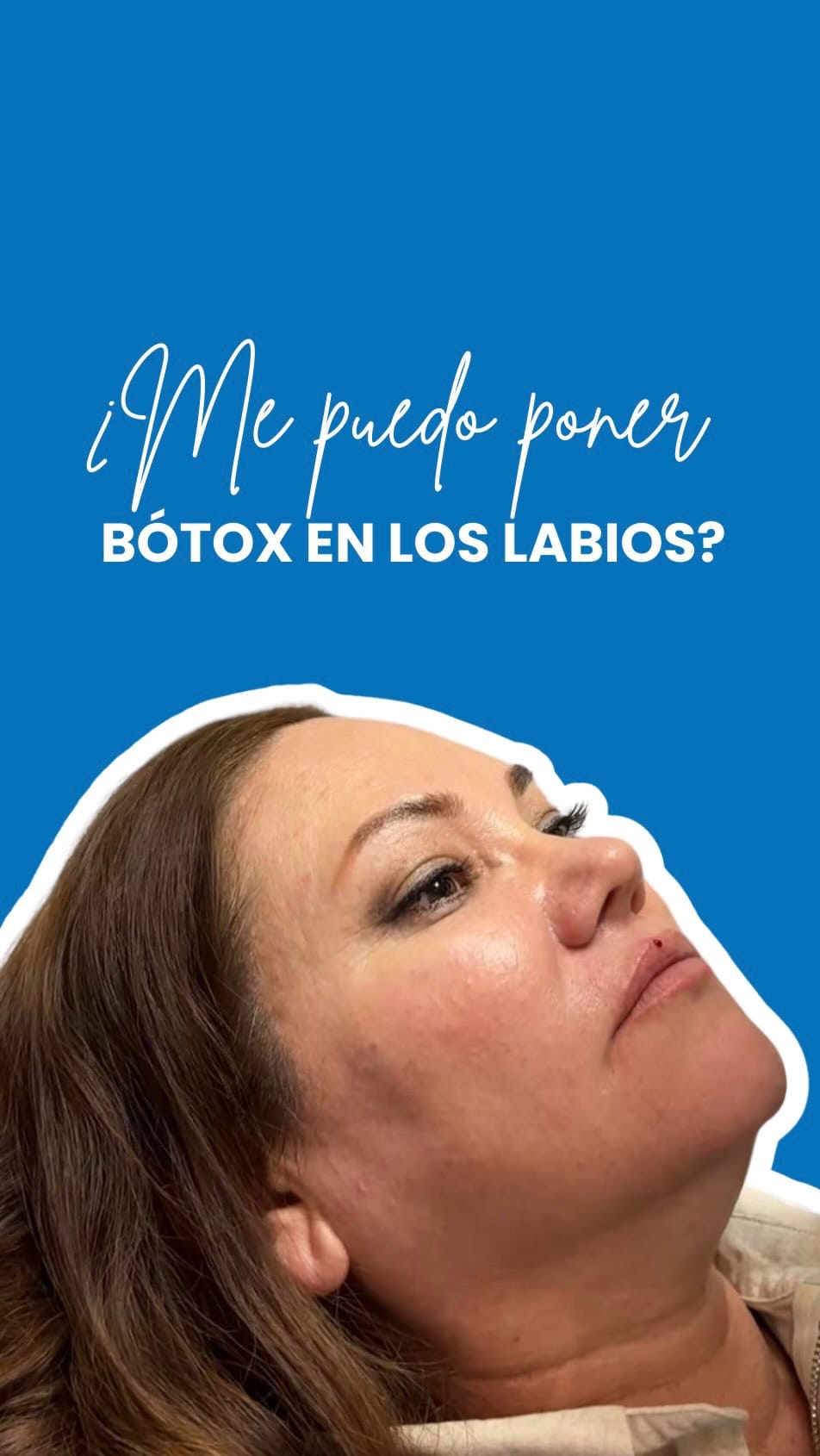 Post 2 by MoldeArte, Rejuvenecimiento sin cirugia on Instagram (video)