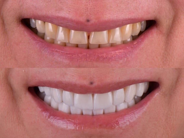 Post 2 by PRODENT AESTHETIC CLINIC on Instagram (carousel)