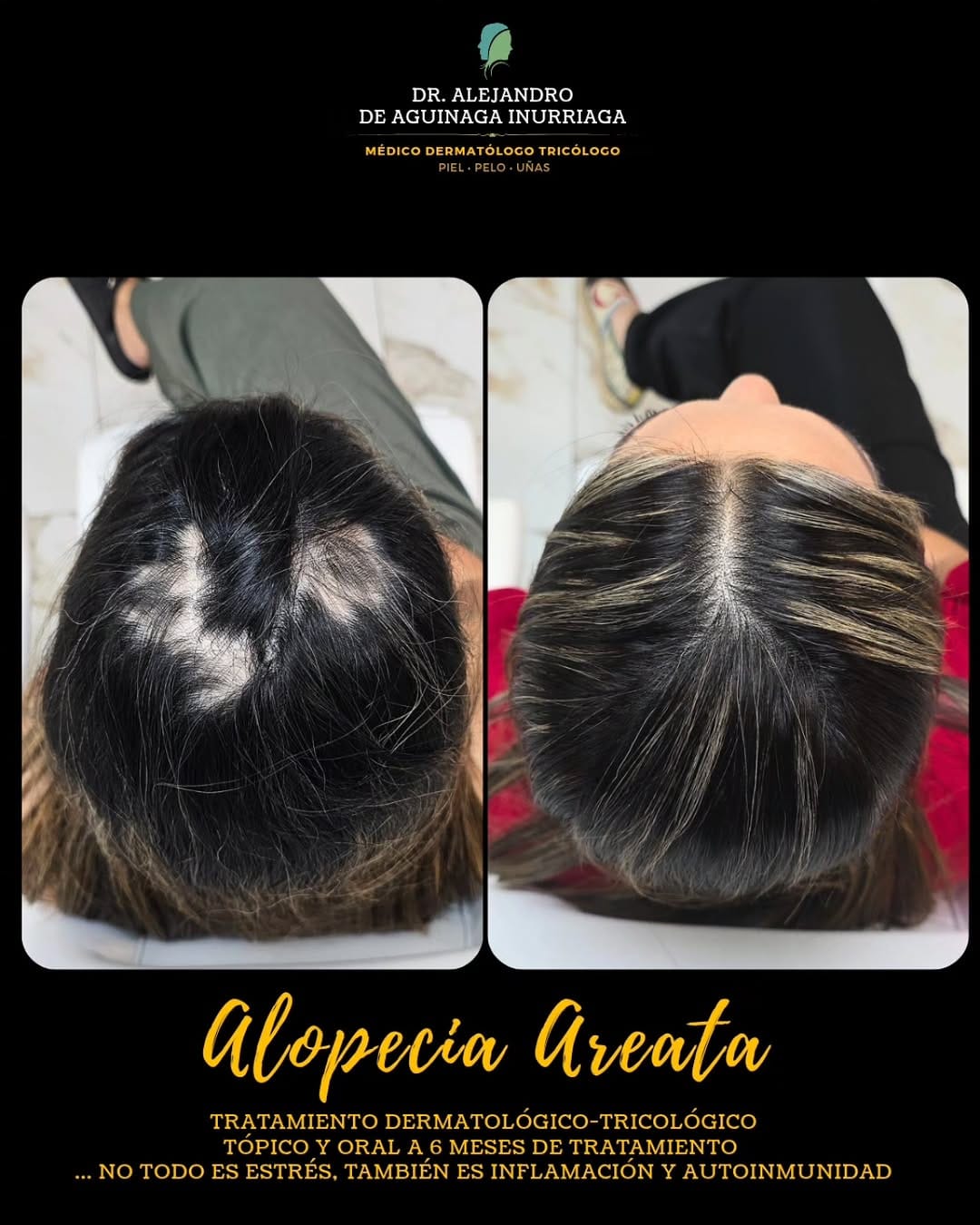 Post 6 by ᴅʀ. ᴀʟᴇᴊᴀɴᴅʀᴏ ᴅᴇ ᴀɢᴜɪɴᴀɢᴀ -
ᴅᴇʀᴍᴀᴛᴏʟᴏɢᴏ ᴛʀɪᴄᴏʟᴏɢᴏ on Instagram (image)