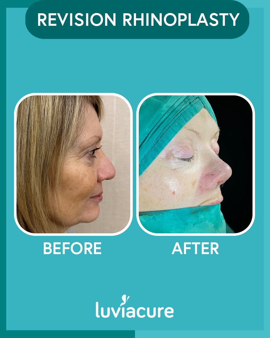 Post 4 by Luviacure Cosmetic Surgery on Instagram (image)