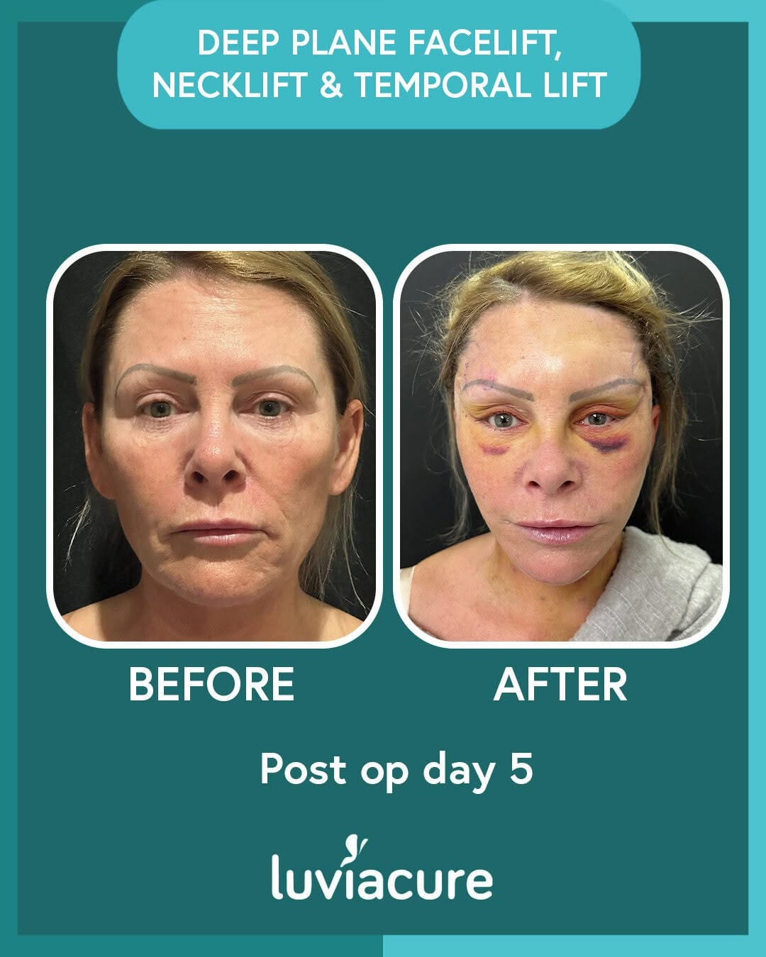 Post 10 by Luviacure Cosmetic Surgery on Instagram (image)