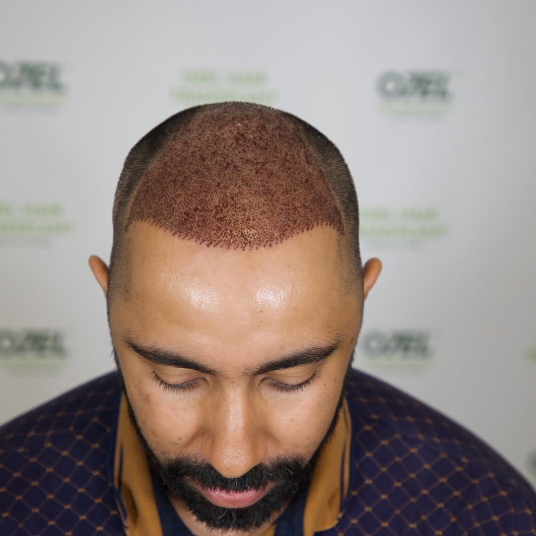 Post 1 by Ozel Hair Transplant on Instagram (carousel)