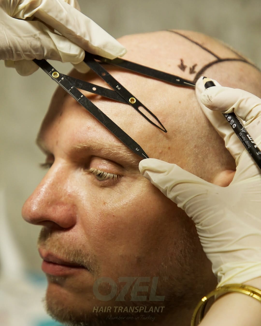 Post 10 by Ozel Hair Transplant on Instagram (carousel)
