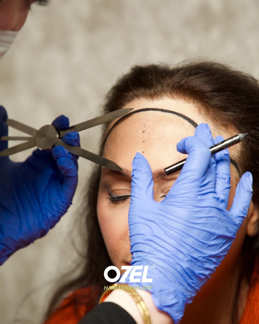 Post 4 by Ozel Hair Transplant on Instagram (carousel)