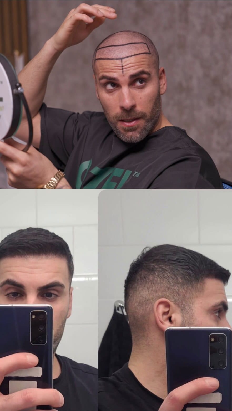Post 8 by Ozel Hair Transplant on Instagram (video)
