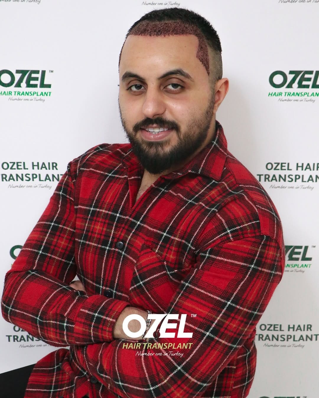 Post 5 by Ozel Hair Transplant on Instagram (carousel)