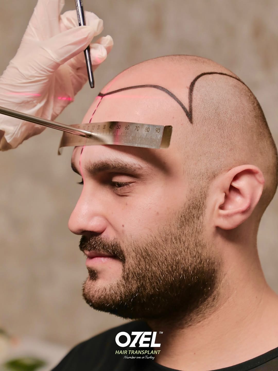 Post 2 by Ozel Hair Transplant on Instagram (image)