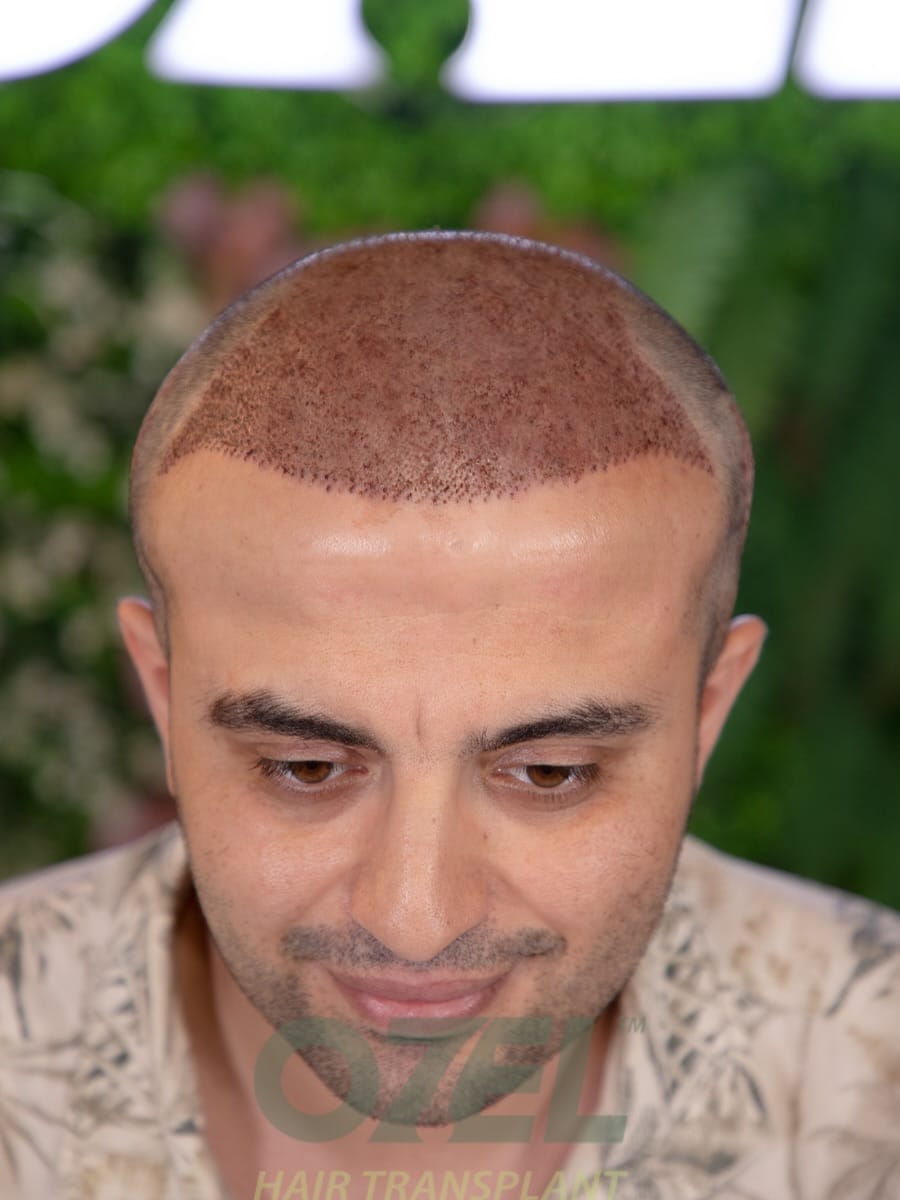 Post 6 by Ozel Hair Transplant on Instagram (carousel)