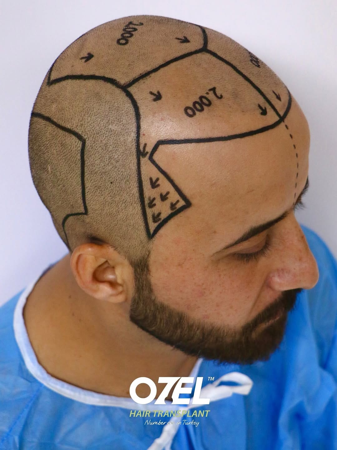 Post 3 by Ozel Hair Transplant on Instagram (carousel)