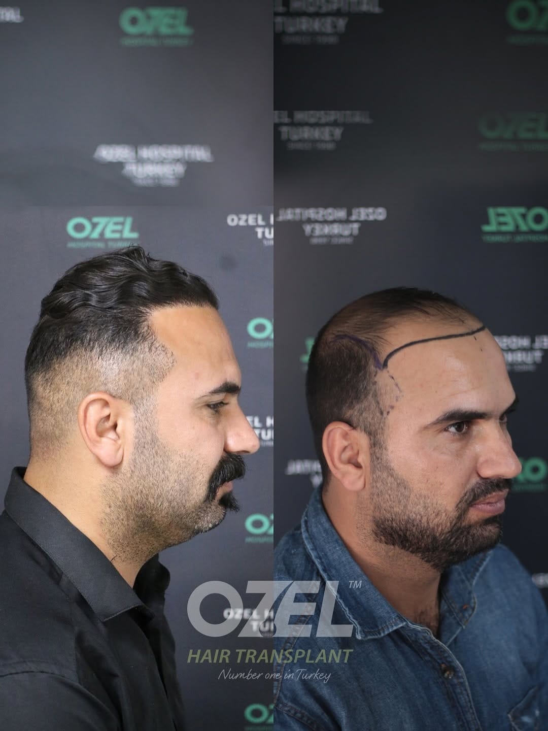 Post 7 by Ozel Hair Transplant on Instagram (carousel)