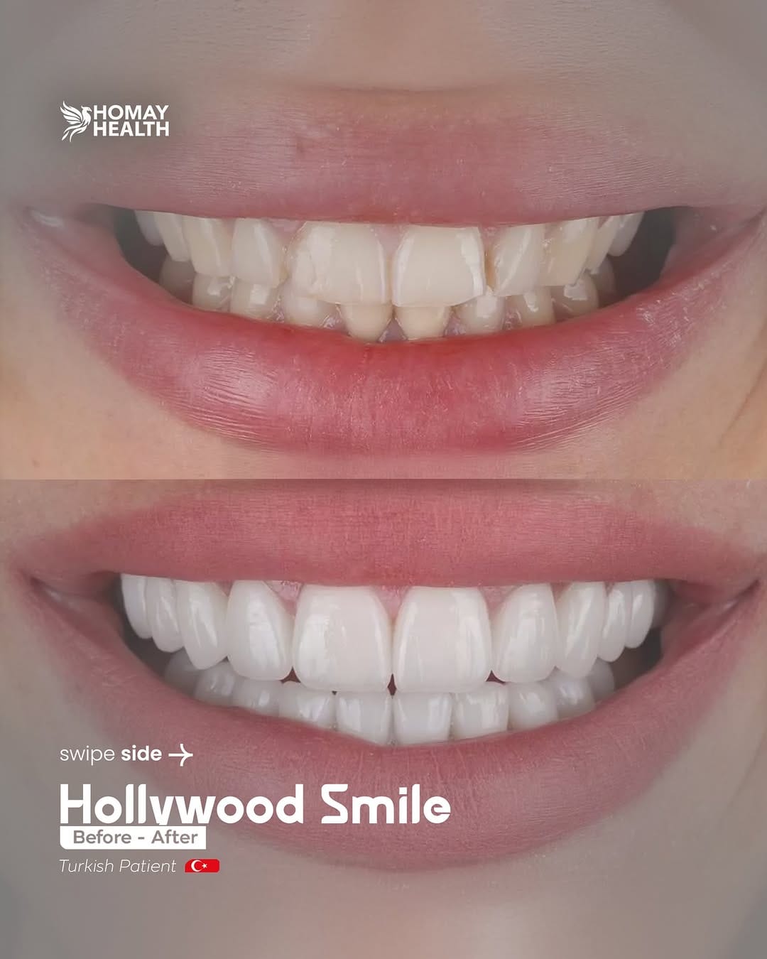 Post 5 by Homay dental on Instagram (carousel)