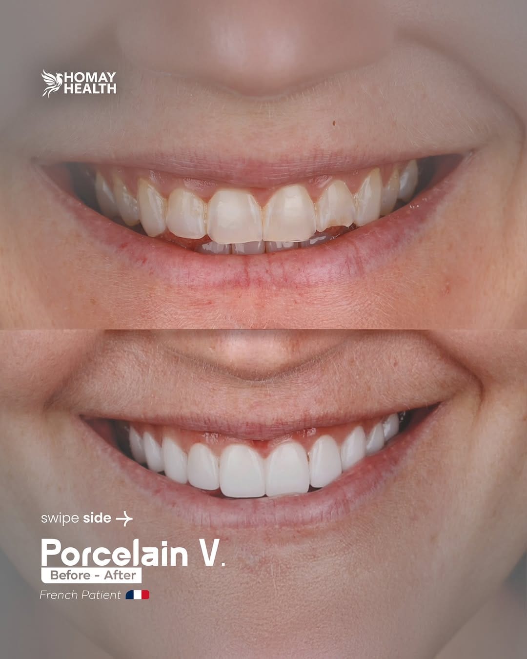 Post 2 by Homay dental on Instagram (carousel)