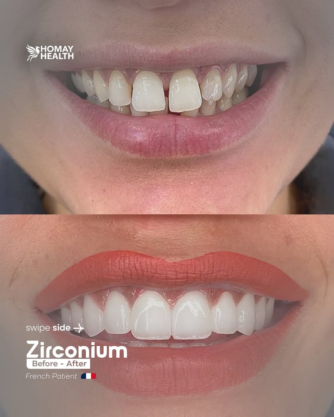 Post 10 by Homay dental on Instagram (carousel)
