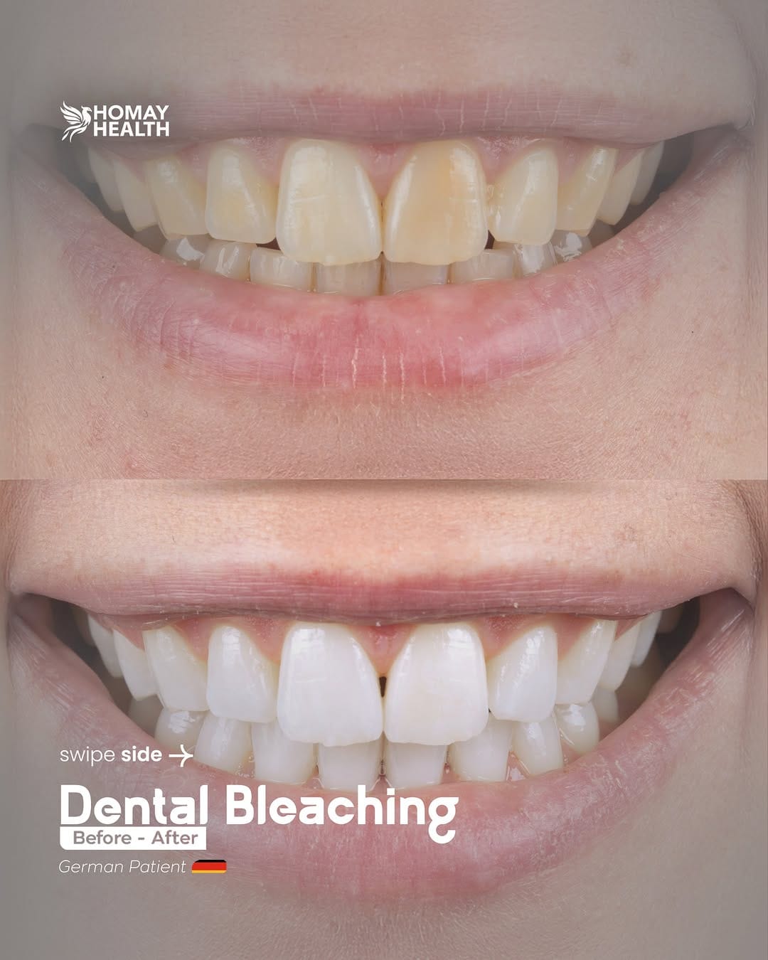 Post 7 by Homay dental on Instagram (carousel)