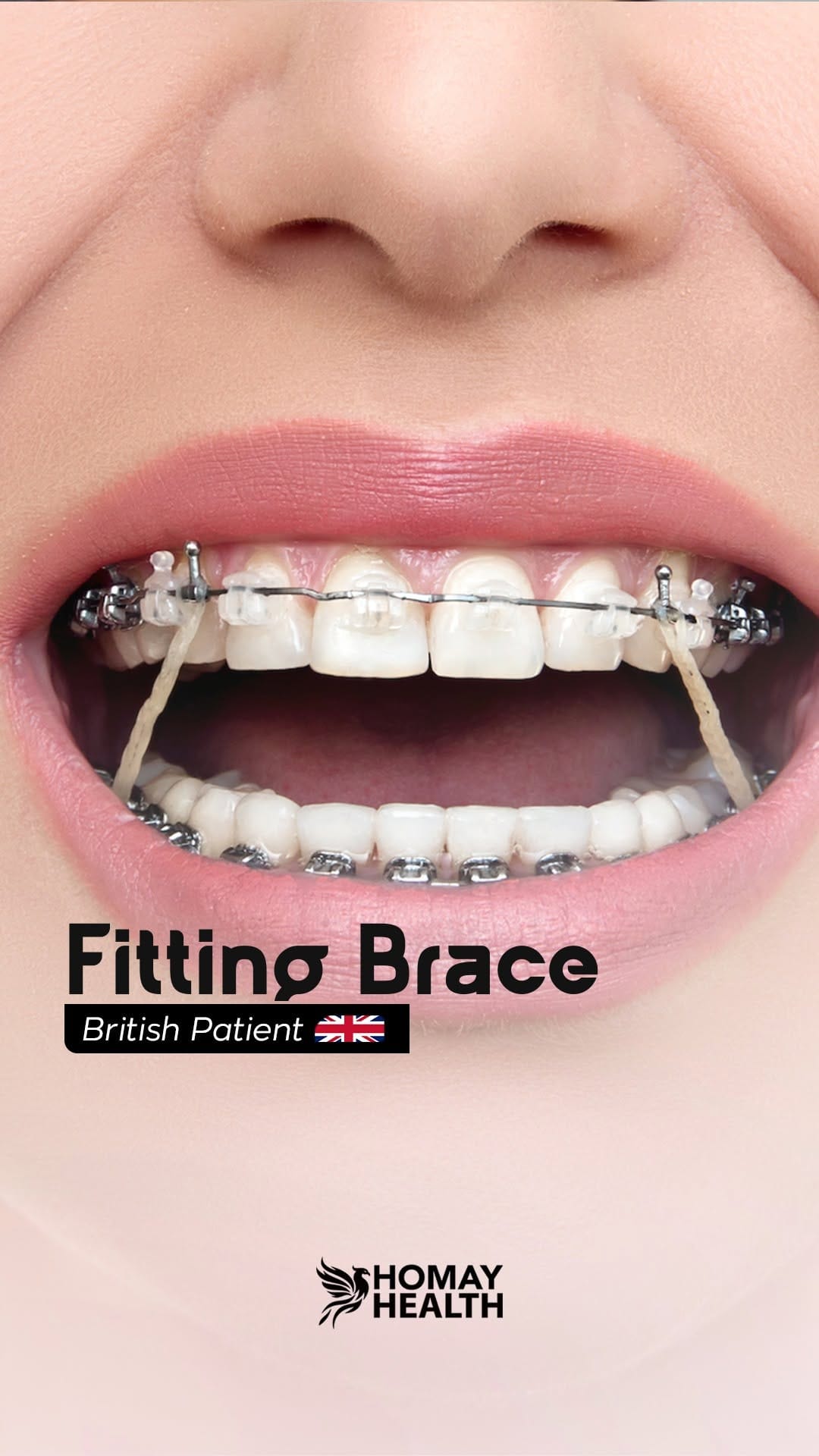 Post 9 by Homay dental on Instagram (video)