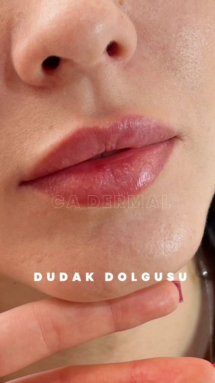 Post 9 by CA Dermal on Instagram (video)