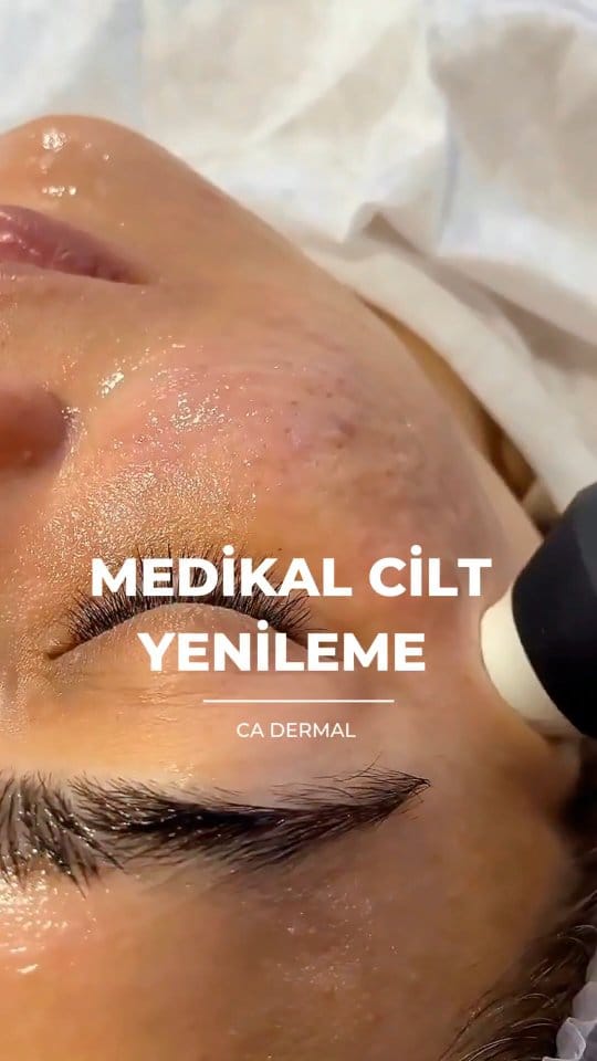 Post 5 by CA Dermal on Instagram (video)