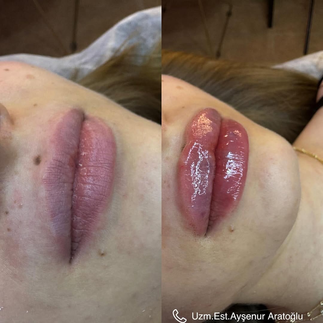 Post 9 by Uzm. Estetisyen Ayşenur Aratoğlu on Instagram (image)