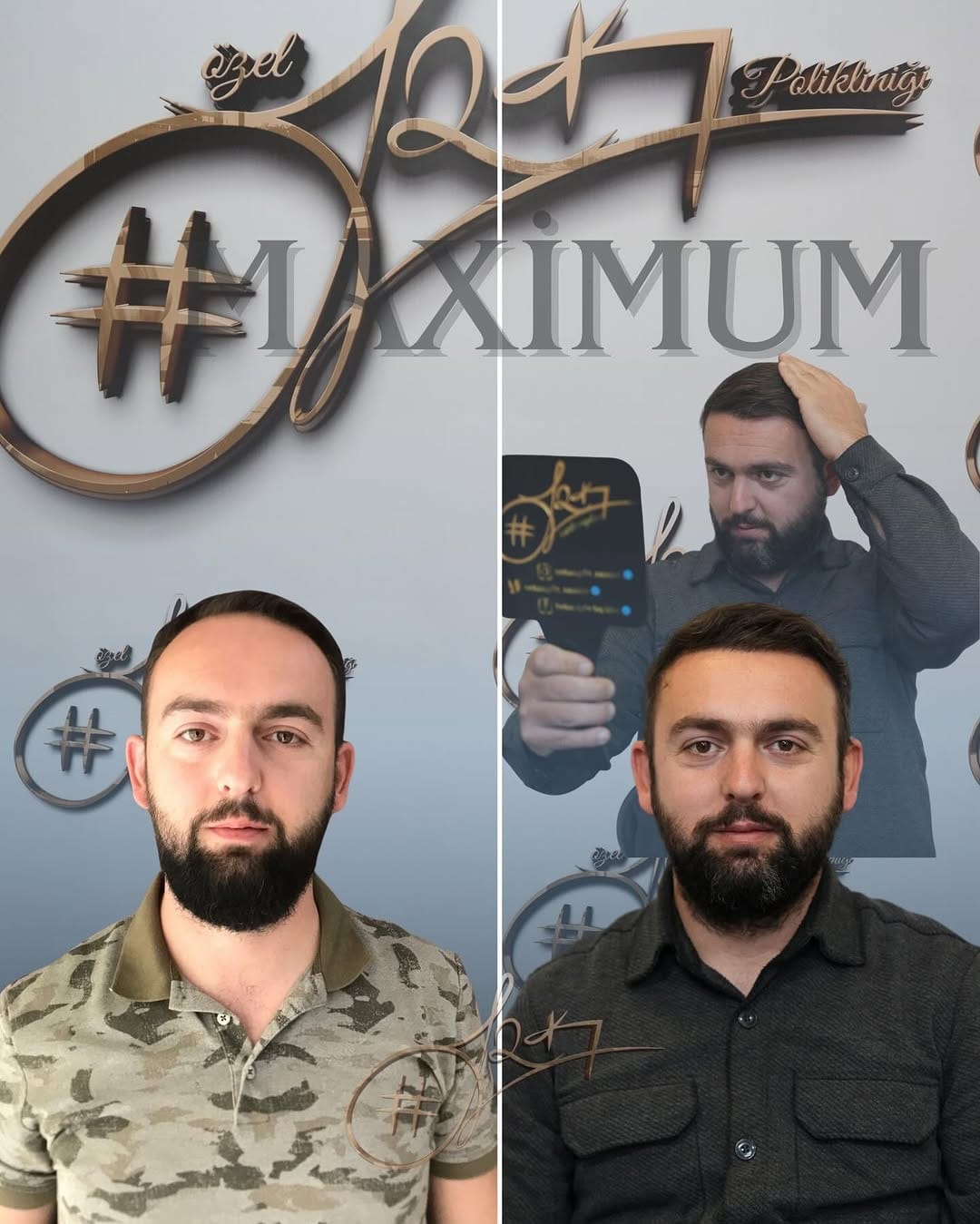 Post 2 by Serkan Aydın Saç Ekimi - Hair Transplant on Instagram (carousel)
