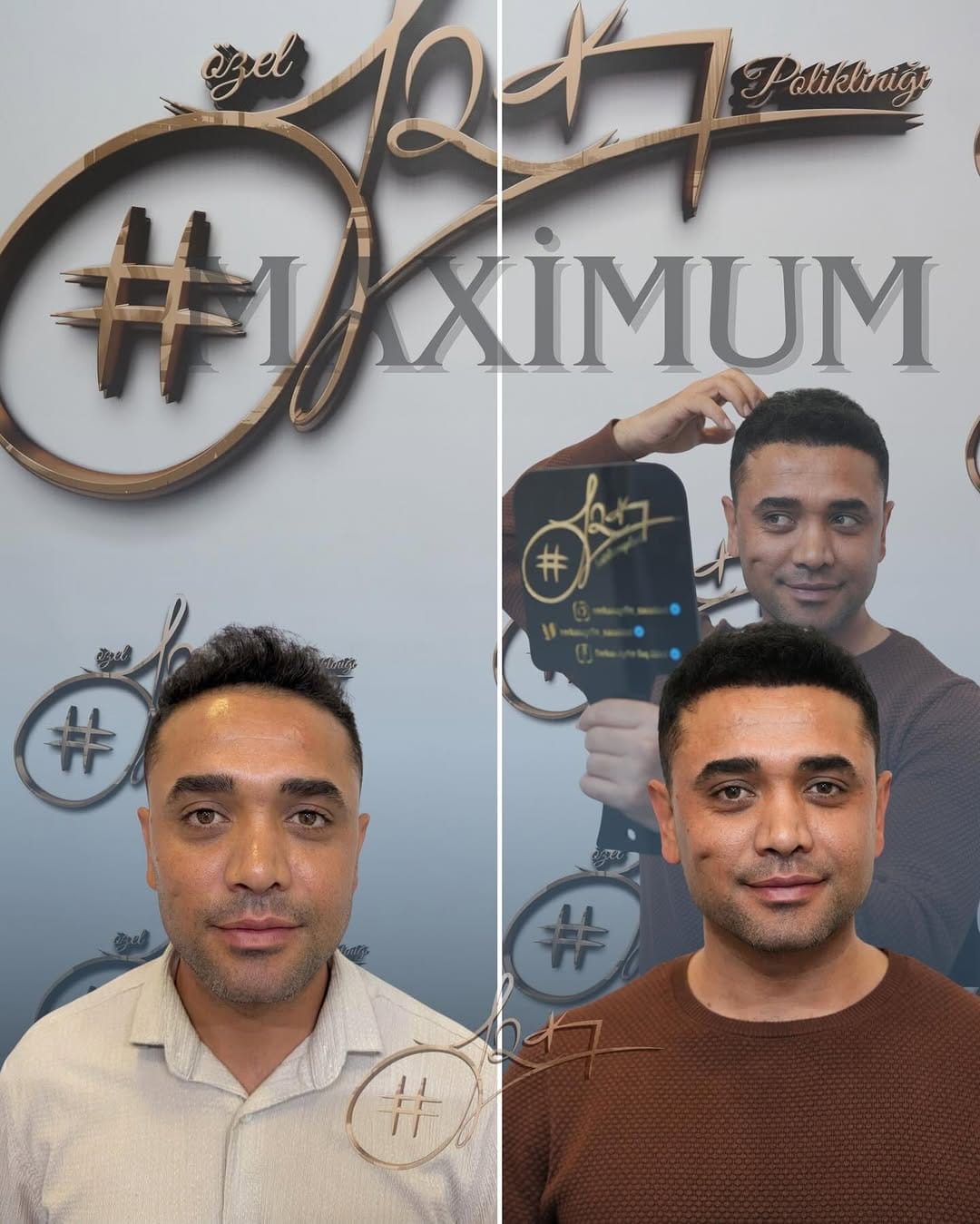 Post 6 by Serkan Aydın Saç Ekimi - Hair Transplant on Instagram (carousel)