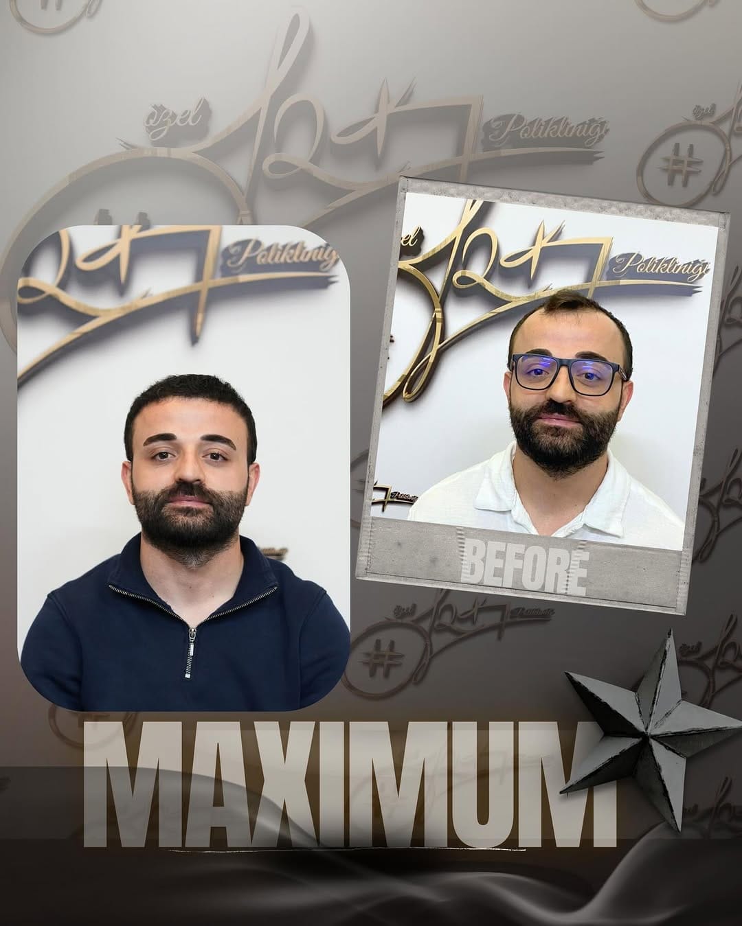 Post 4 by Serkan Aydın Saç Ekimi - Hair Transplant on Instagram (carousel)