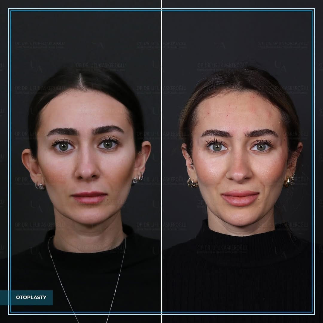 Post 10 by Op.Dr. Ufuk Askeroglu on Instagram (carousel)