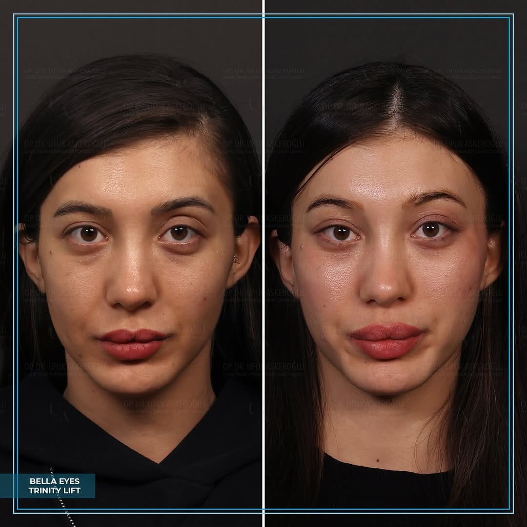Post 4 by Op.Dr. Ufuk Askeroglu on Instagram (carousel)