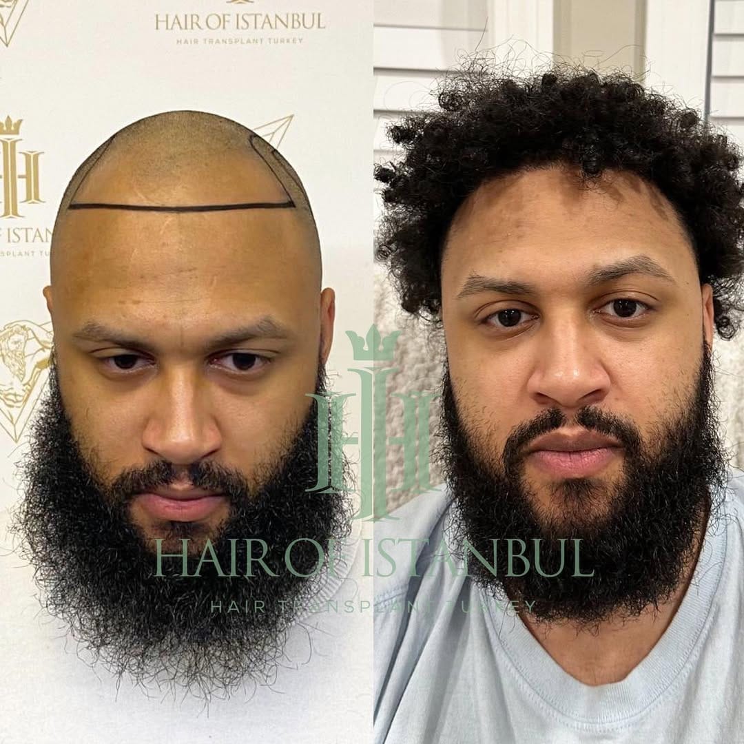 Post 10 by Hair of İstanbul | Hair Transplant Clinic on Instagram (carousel)