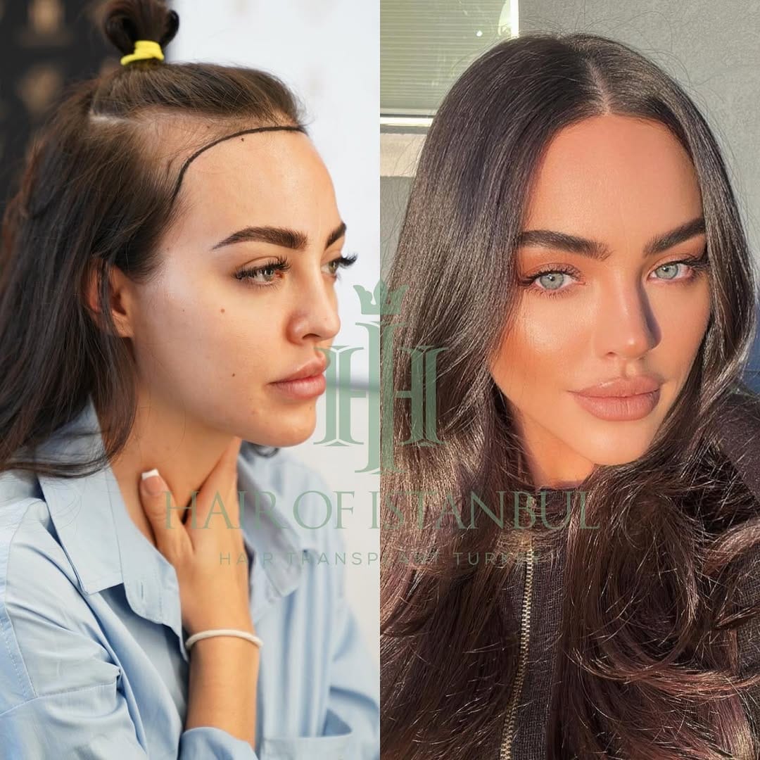Post 9 by Hair of İstanbul | Hair Transplant Clinic on Instagram (carousel)