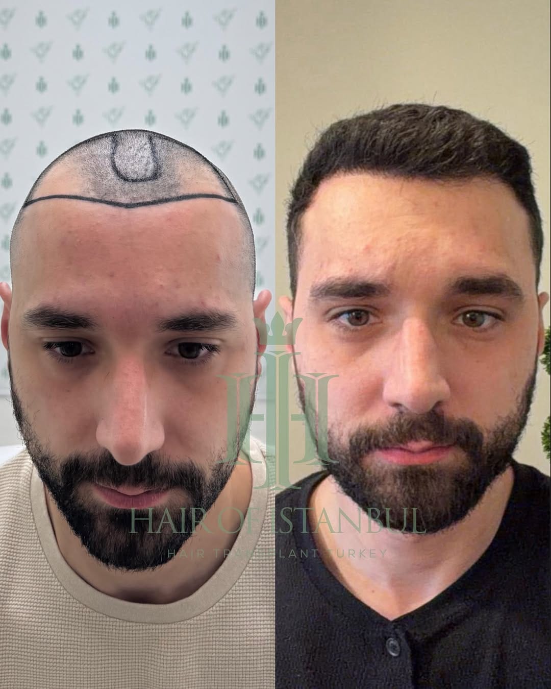 Post 4 by Hair of İstanbul | Hair Transplant Clinic on Instagram (carousel)