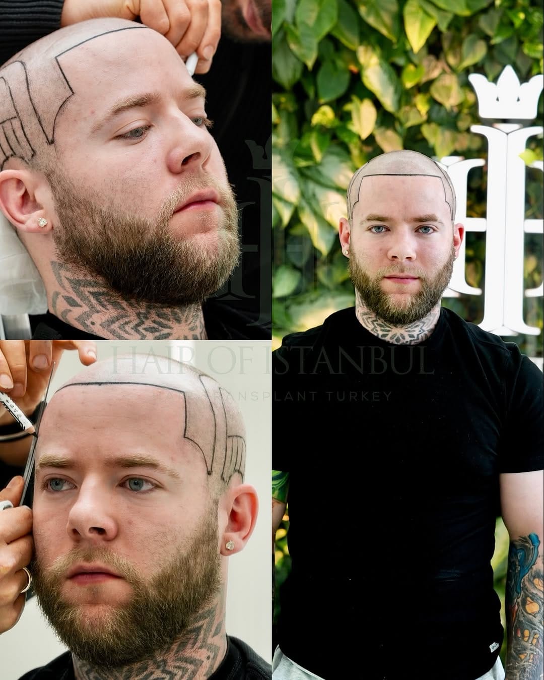 Post 6 by Hair of İstanbul | Hair Transplant Clinic on Instagram (image)