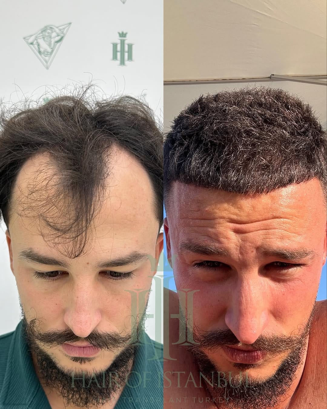 Post 8 by Hair of İstanbul | Hair Transplant Clinic on Instagram (carousel)