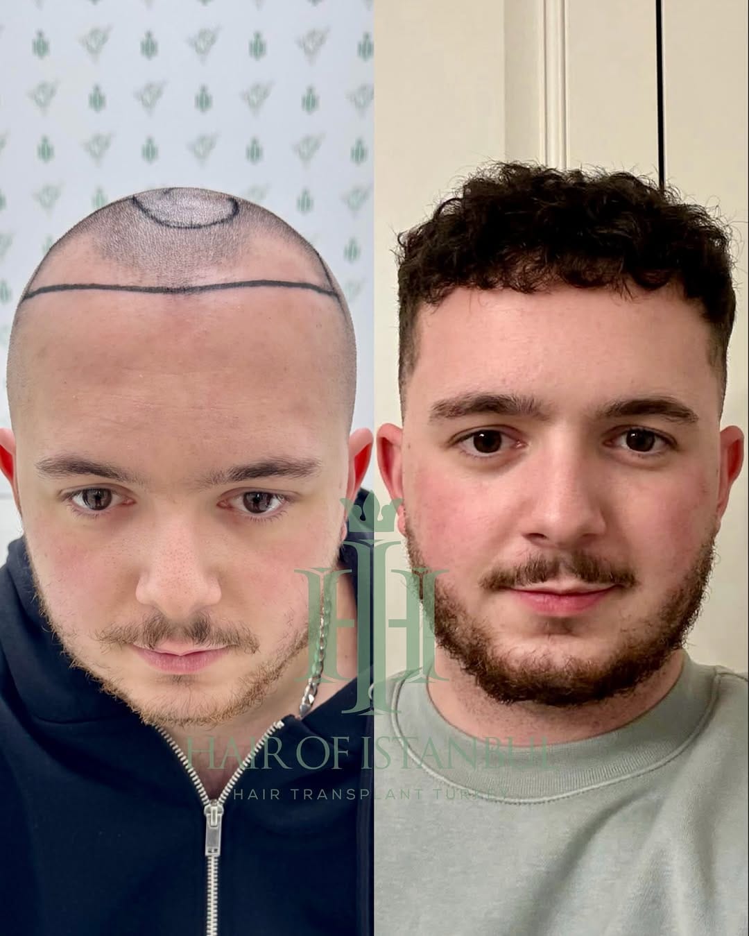Post 5 by Hair of İstanbul | Hair Transplant Clinic on Instagram (carousel)