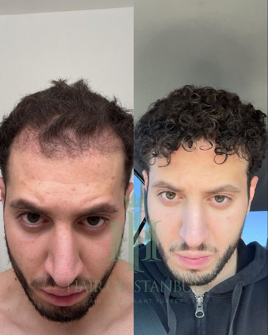 Post 1 by Hair of İstanbul | Hair Transplant Clinic on Instagram (carousel)