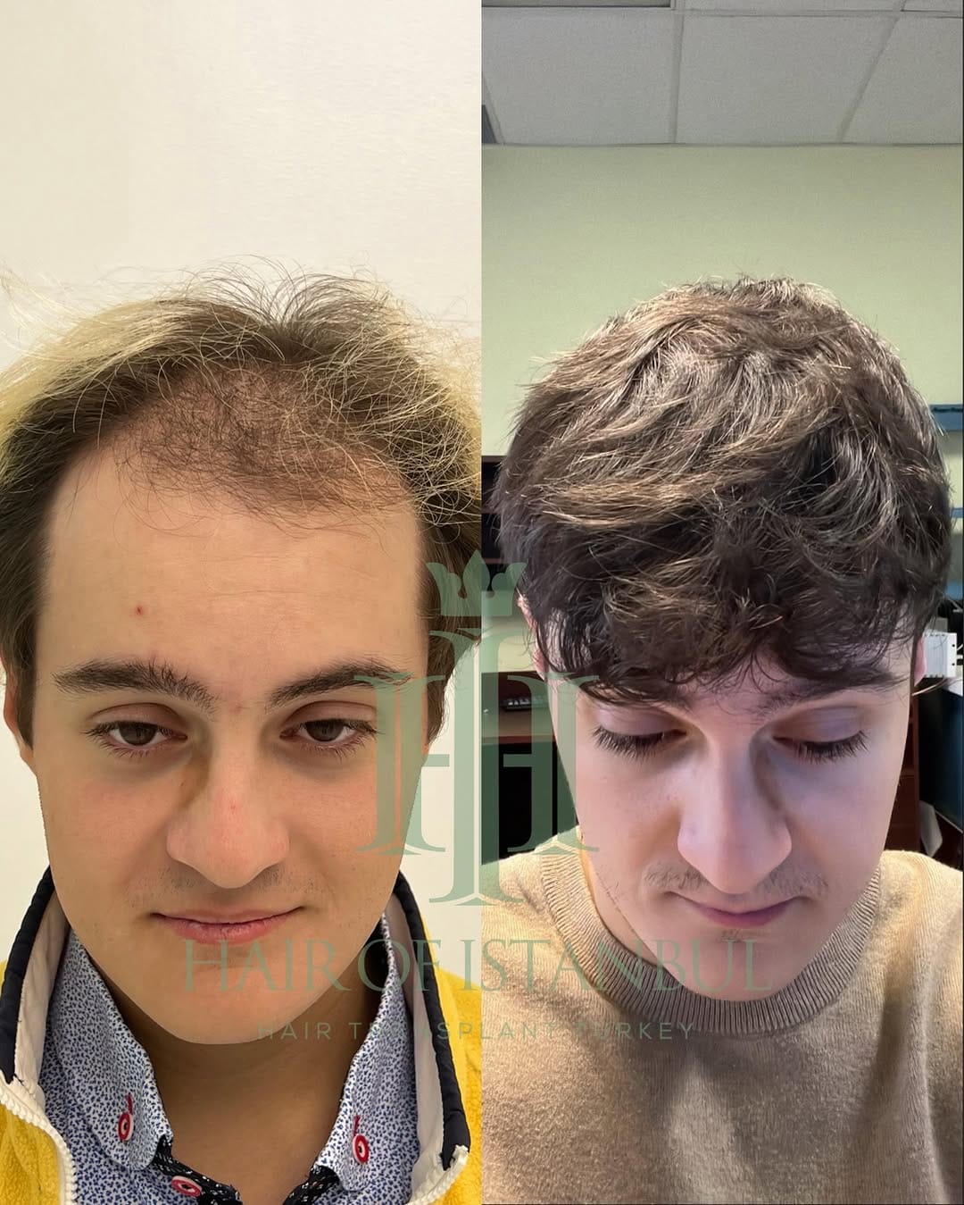 Post 2 by Hair of İstanbul | Hair Transplant Clinic on Instagram (carousel)