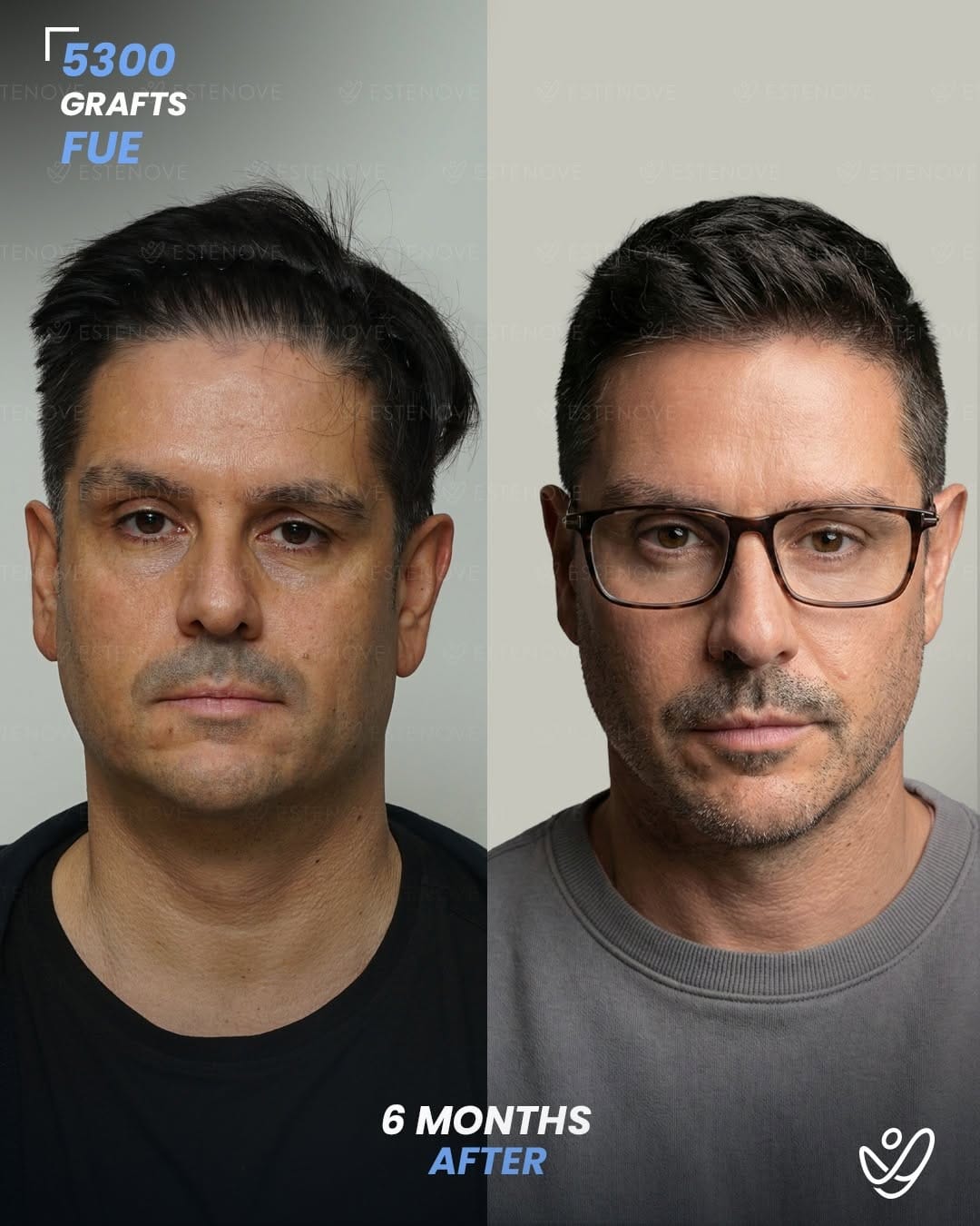 Post 2 by Estenove Hair Transplant Turkey on Instagram (carousel)