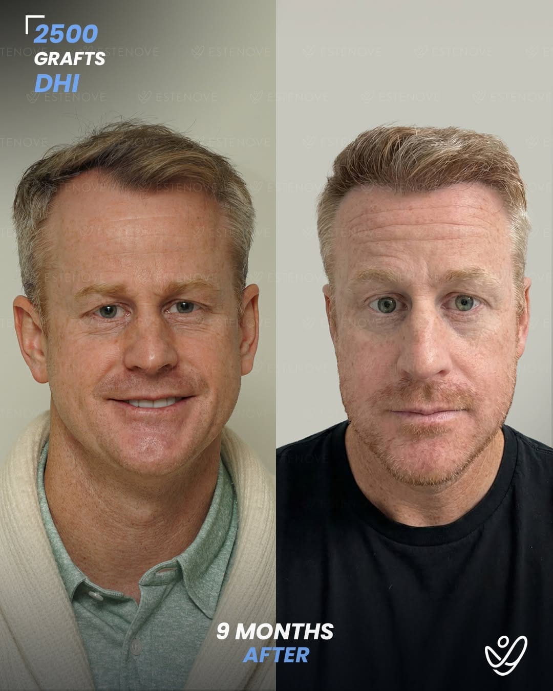 Post 5 by Estenove Hair Transplant Turkey on Instagram (carousel)