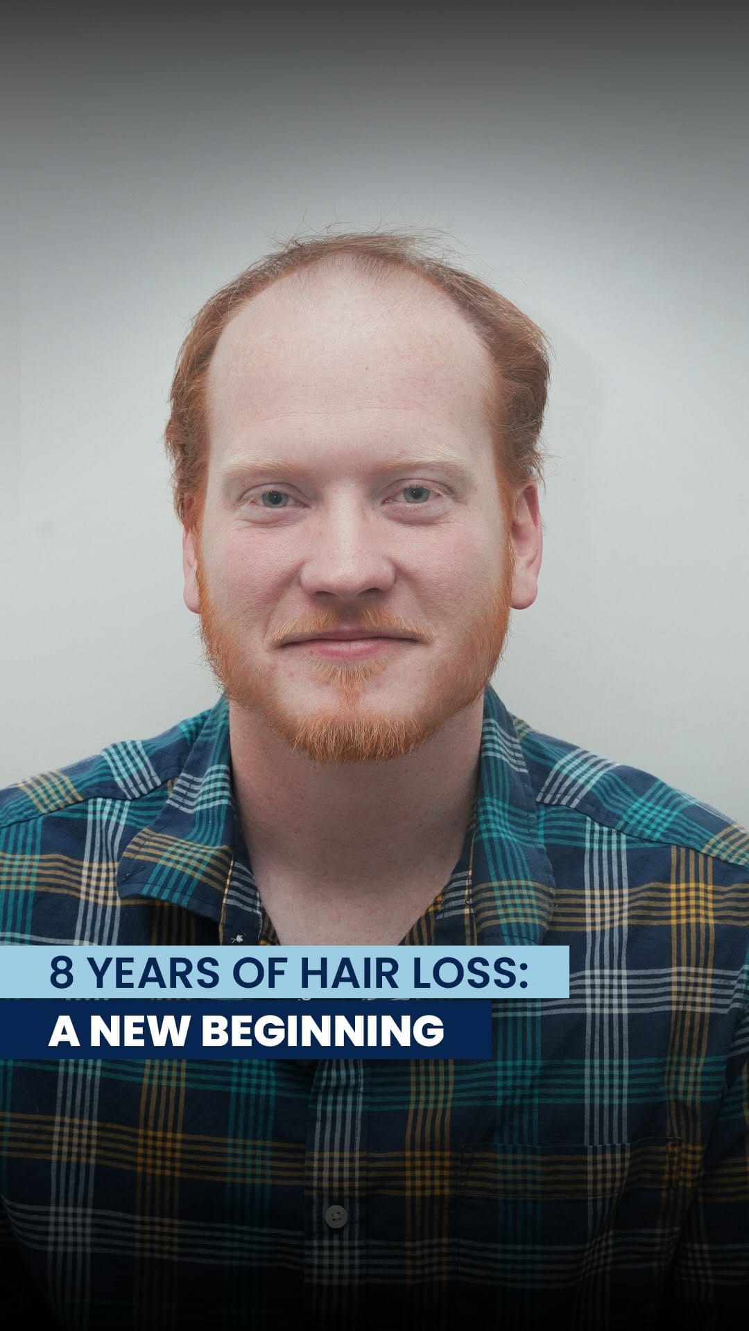 Post 4 by Estenove Hair Transplant Turkey on Instagram (video)