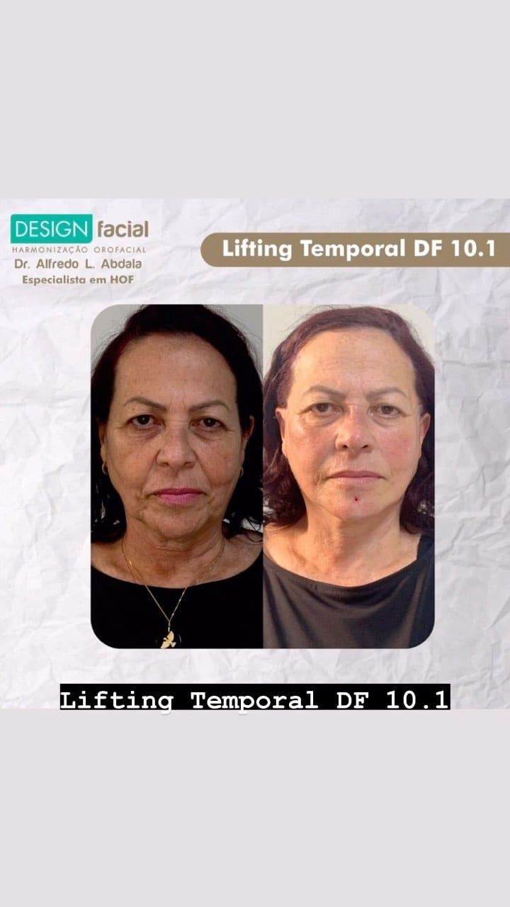 Post 10 by Dr Alfredo Lemos Abdala - DESIGN FACIAL on Instagram (video)