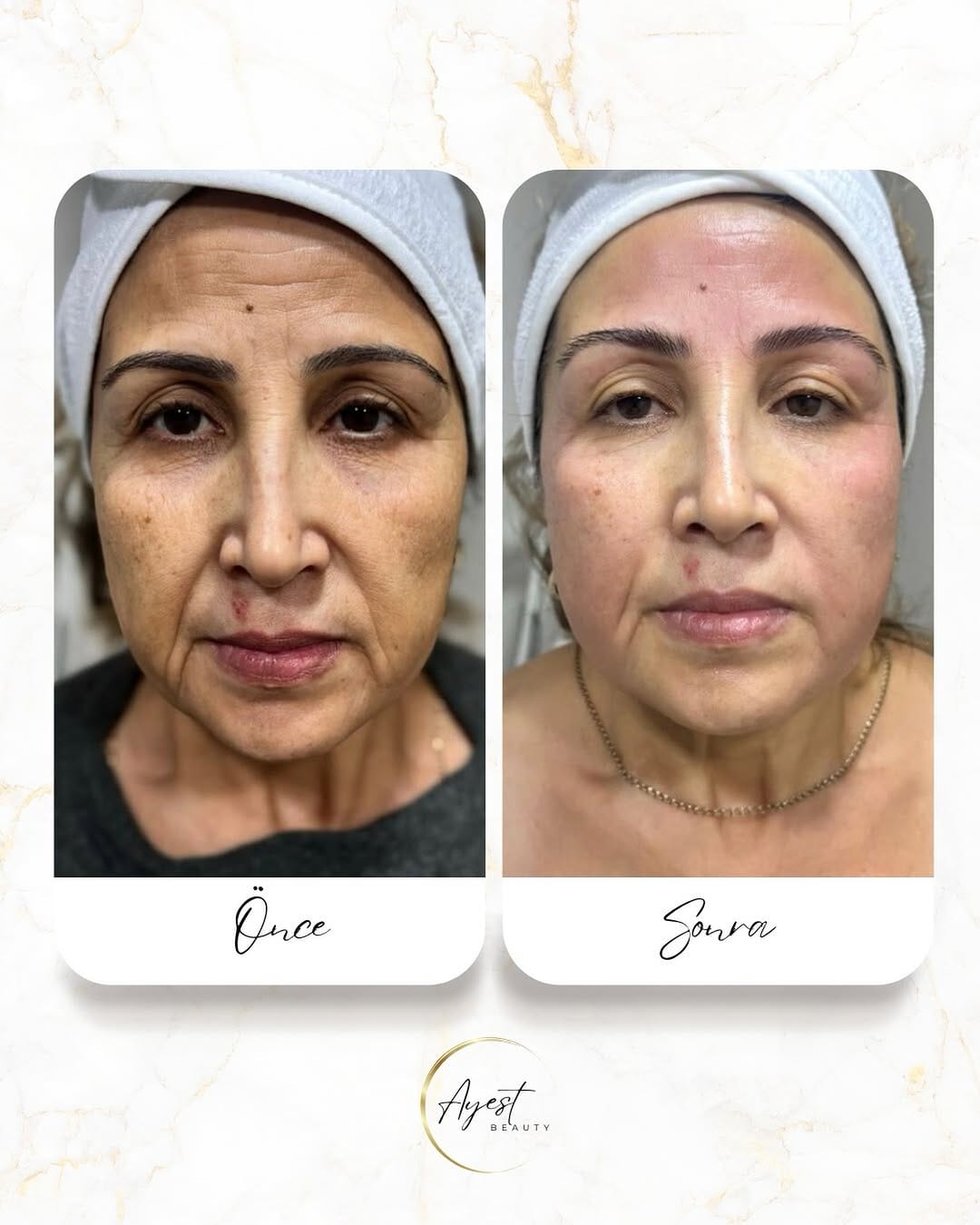 Post 2 by AYEST GÜZELLİK SALONU on Instagram (image)