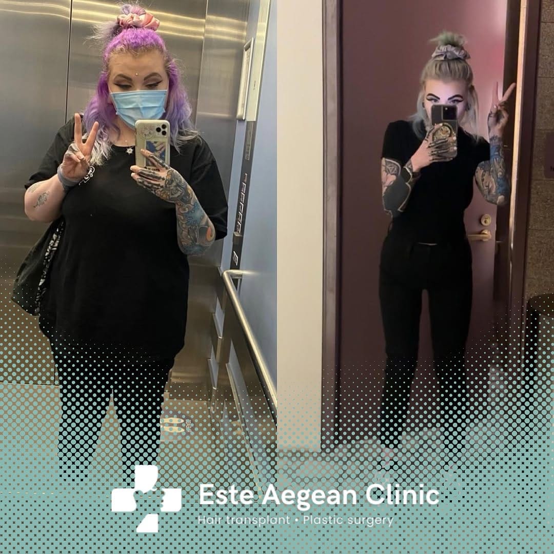 Post 5 by Este Aegean Clinic - Gastric Sleeve on Instagram (image)