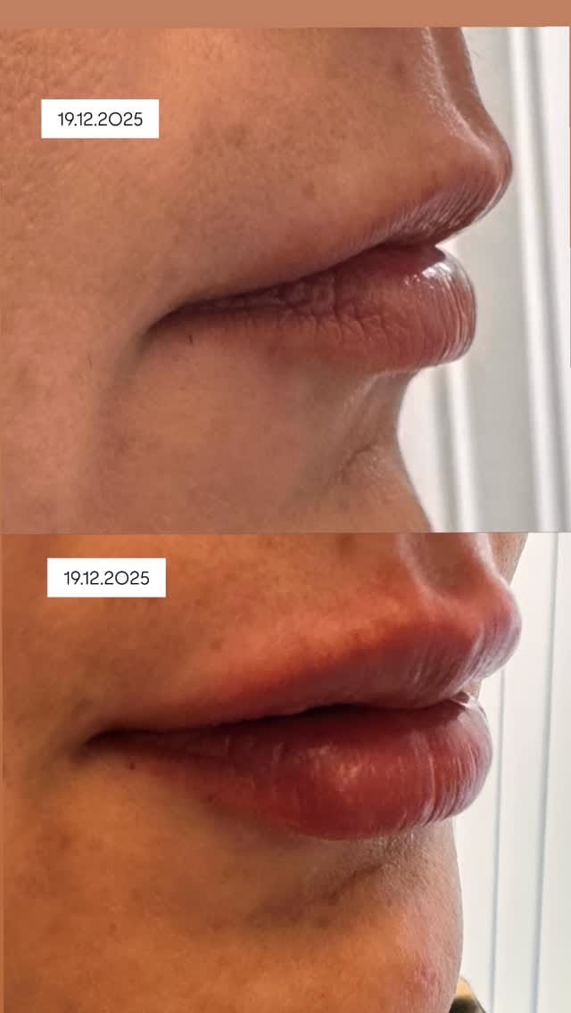 Post 9 by Dermatolog Dr. Ayşe Naren on Instagram (video)