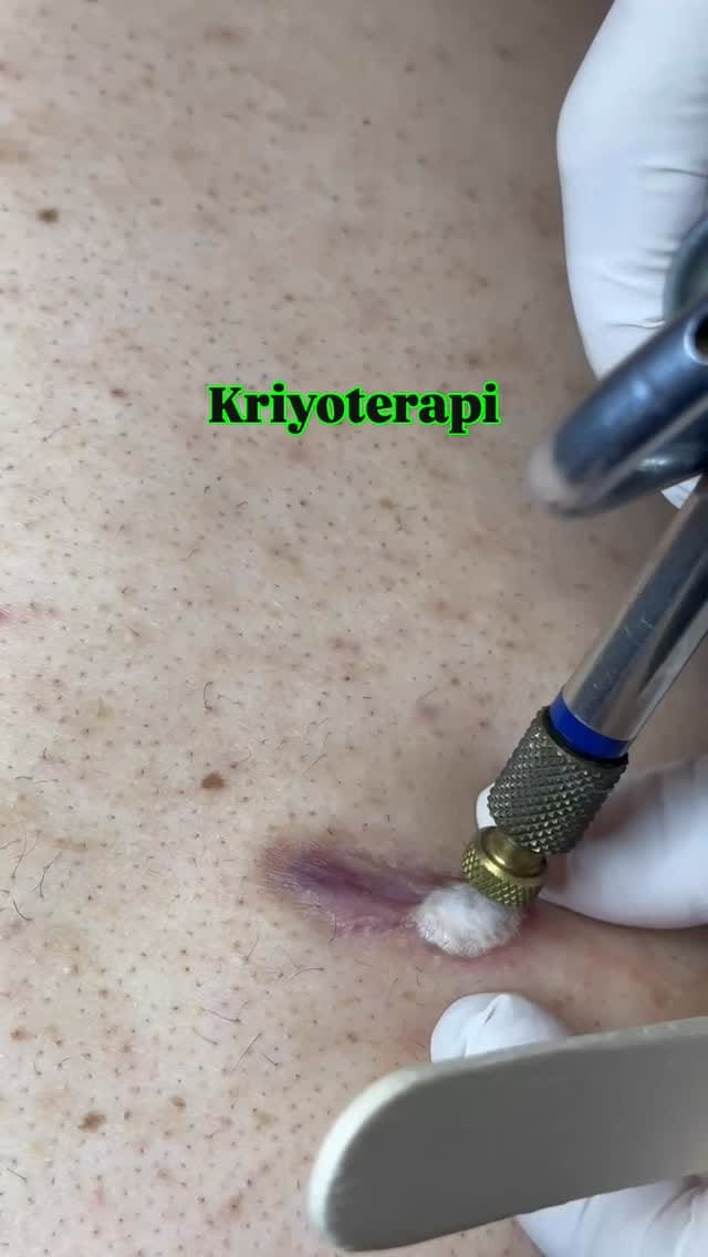 Post 4 by Dermatolog Dr. Ayşe Naren on Instagram (video)