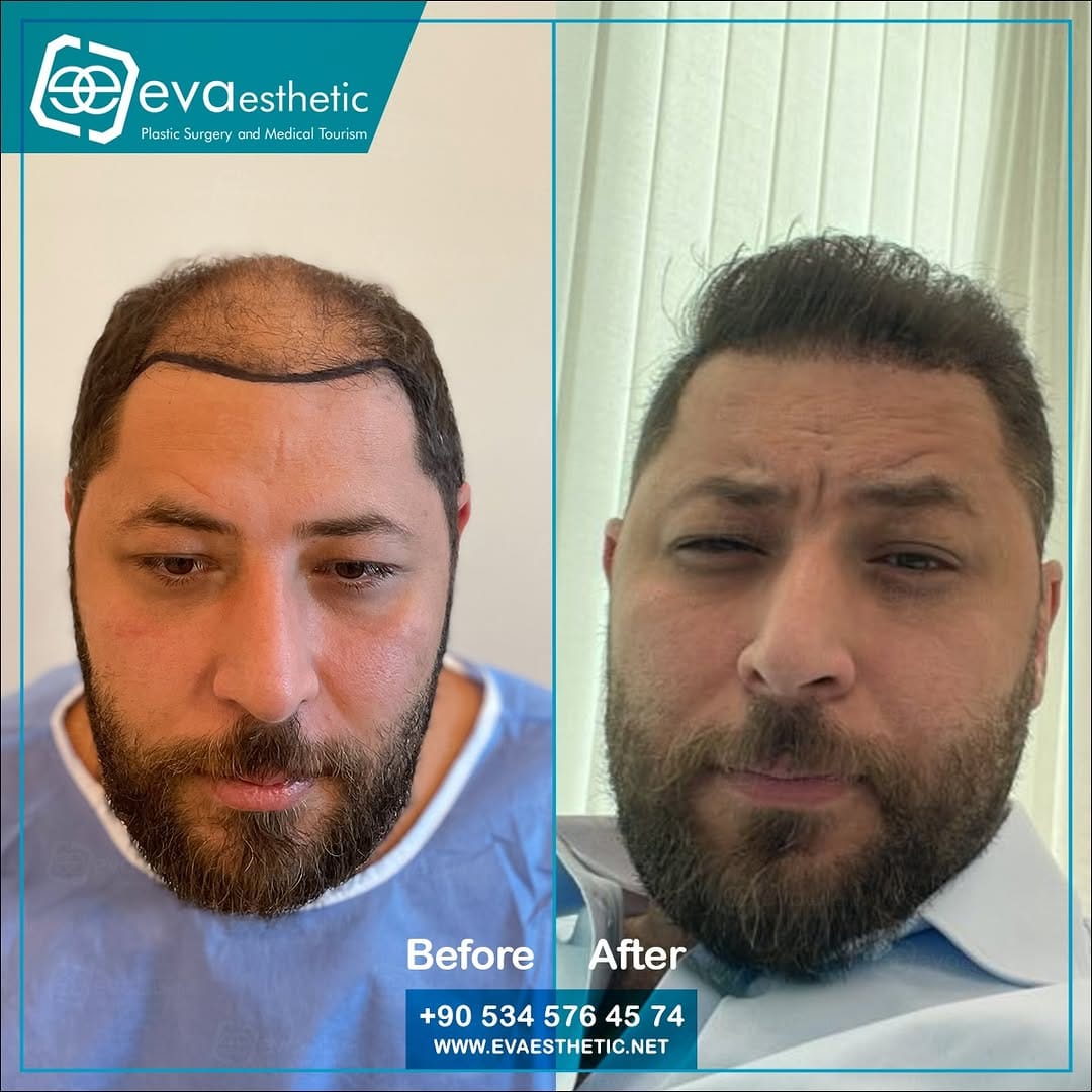 Post 7 by Hair Taransplant In Turkey on Instagram (carousel)