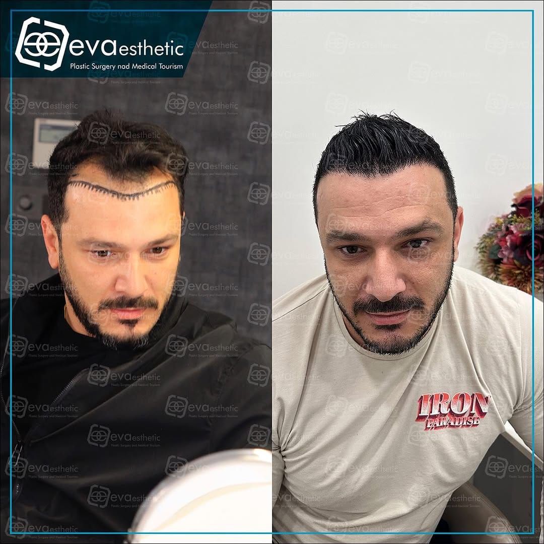 Post 10 by Hair Taransplant In Turkey on Instagram (carousel)